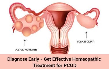 Find Effective Homeopathic Medicine & Treatment for PCOD